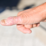 Kartläggningen av psoriasisartitgen ett genombrott i psoriasisforskningen